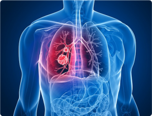 Best Pulmonology Hospital In Hyderabad