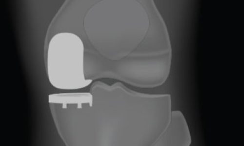 partial knee replacement surgery